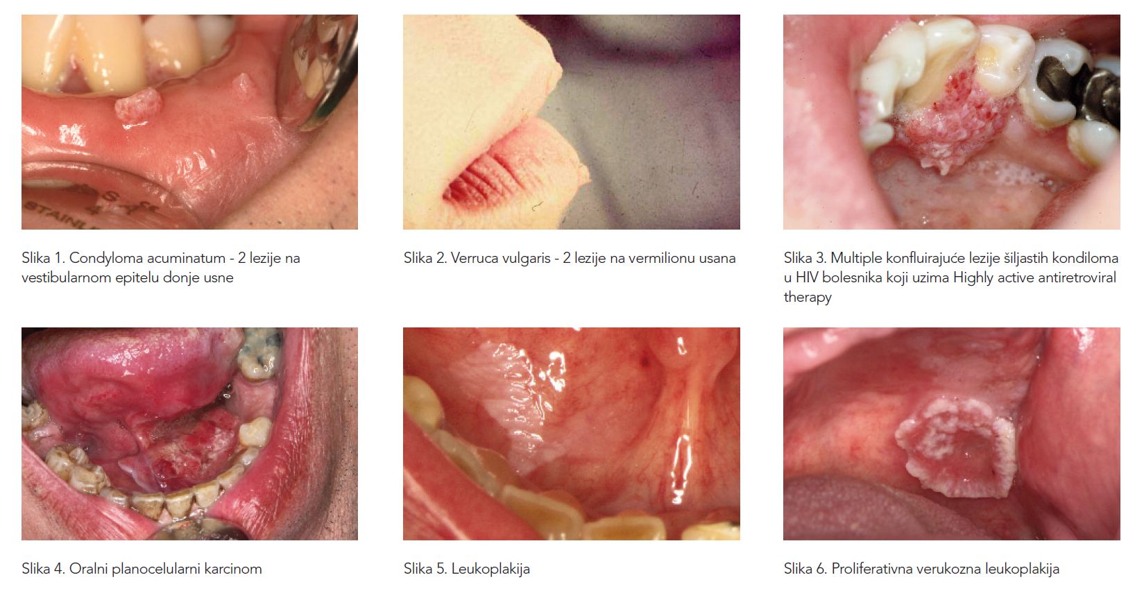 humán papilloma vírus és ustima rák nyelvcsúcsa