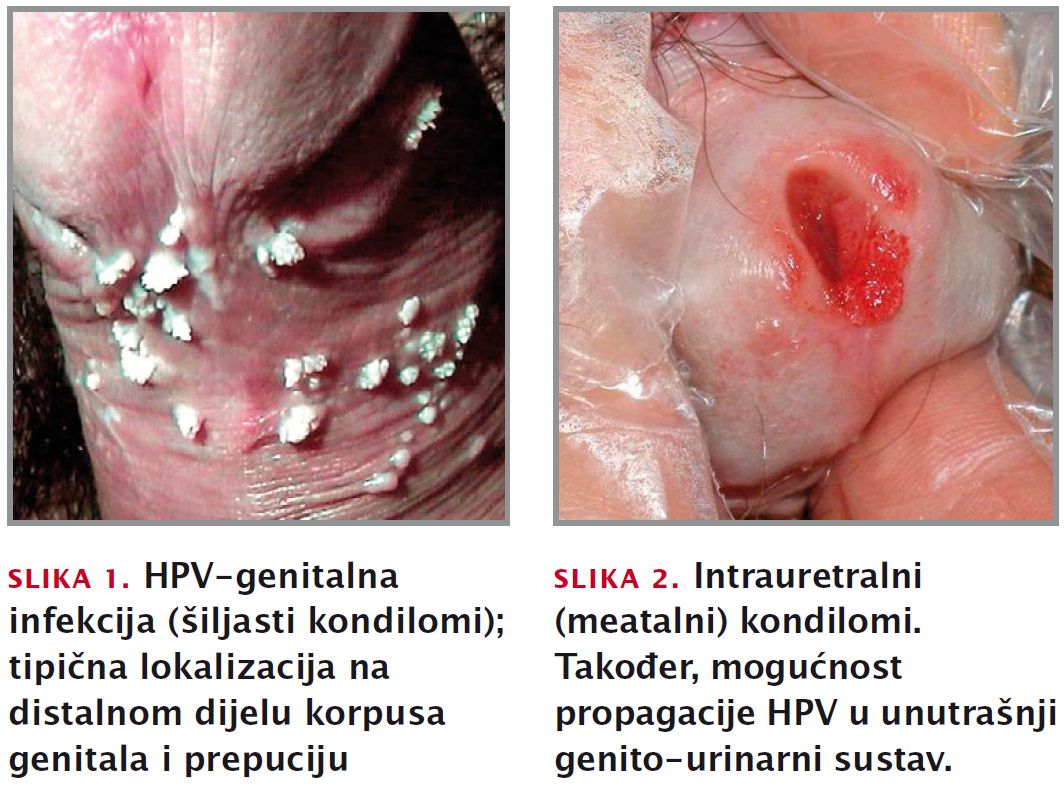 hpv vakcina kondilomer)